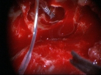 Za_o_enie_implantu.jpg